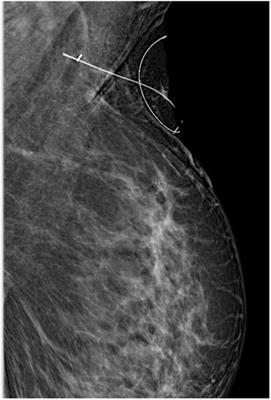 Feasibility and accuracy of targeted axillary dissection in breast cancer patients; single center experience